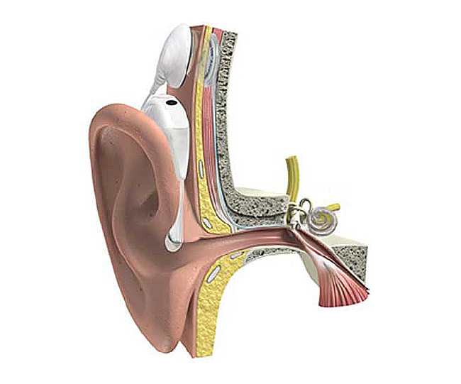 PAM Argentina Implante Coclear Solucion de por vida