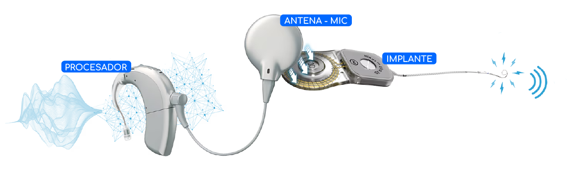 PAM Argentina Implante Coclear Tecnologias destacadas