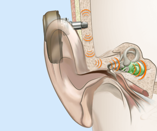 PAM Argentina Implante de conduccion osea Implante de conduccion osea